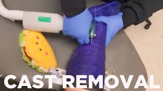 How Leg Cast is Removed  Ankle Fracture  Cast Removal Secrets [upl. by Quince833]