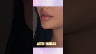 Lip Filler Treatment results in BandraMumbai [upl. by Serle]