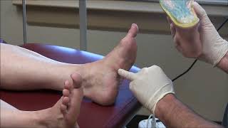 Painful Plantar Fibromas in Feet [upl. by Nnyw]