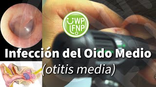 Infección del Oido Medio otitis media [upl. by Lilac]