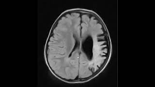 encephalitis what is similar [upl. by Odragde]