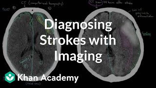 Diagnosing strokes with imaging CT MRI and Angiography  NCLEXRN  Khan Academy [upl. by Ayana607]