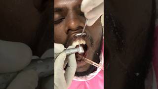 உடைந்த பல் சரி செய்தல்  Fixing broken teeth Dr Dinesh Kowsky [upl. by Bodi392]