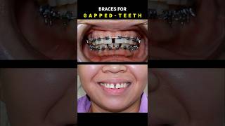 BRACES FOR GAPPED TEETH 32 MONTHS DURATION braces orthodontist dentist [upl. by Caralie]