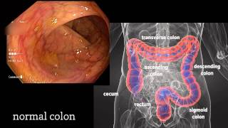 Colonoscopy A Journey Though the Colon and Removal of Polyps [upl. by Retsek]