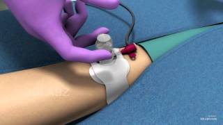 Medical device 3D Animation  Forge Medical Philadelphia United States [upl. by Placida]