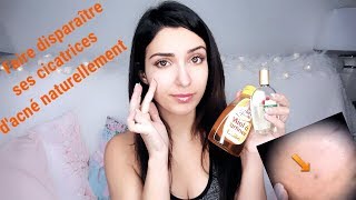 Comment faire partir les cicatrices dacné  astuce efficace et naturelle [upl. by Gustave]