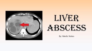 Liver abscess  pyogenicamoebicfungal route of spread sign and symptom investigation treatment [upl. by Thurmond]