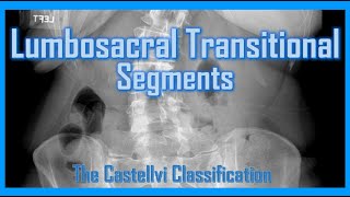 Lumbosacral Transitional Segments  LSTV anatomy radiology medical [upl. by Alaek]