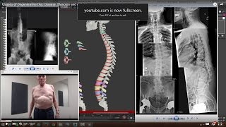 Causes of Degenerative Disc Disease Stenosis and Arthritis [upl. by Nnayhs]