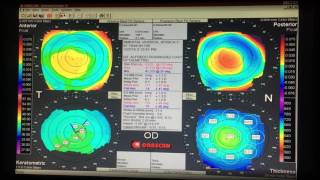 Topografía Corneal [upl. by Lunseth]