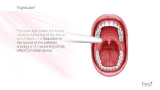 NightLase laser for snoring and sleep apnea [upl. by Neetsuj]