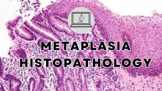 METAPLASIA  HISTOPATHOLOGY AND MORPHOLOGY [upl. by Nalniuq]