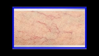 Varicosités aux jambes  remèdes naturels [upl. by Franni789]