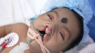 Rare Cleft Baby Going under Sleep Anesthesia [upl. by Fugate]