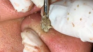 Giant blackheads dial treatment [upl. by Adnwahsar]