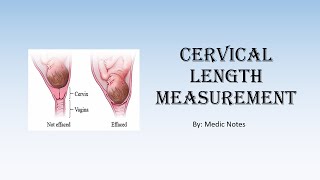 Cervical length measurement  transabdominaltransvaginal ultrasound management of shortened cervix [upl. by Yann]