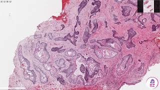 Ameloblastoma Conventionalmulticystic type [upl. by Ecirtnahs]