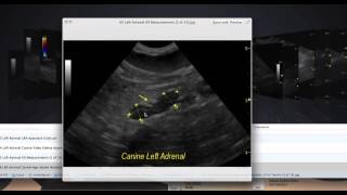 How to Find Those Difficult Adrenal Glands [upl. by Gilroy]