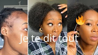 COMMENT FAIRE POUSSÉ SES CHEVEUX DU DEVANTAlopécieSolution Efficace [upl. by Arotak]