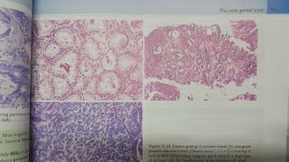 Prostatic Adenocarcinoma  SPECIAL PATHOLOGY [upl. by Rotciv586]