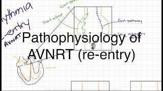 Pathophysiology of AVNRT [upl. by Ennasil]