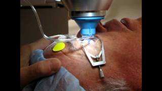 Laser Assisted Cataract Surgery [upl. by Fabyola204]