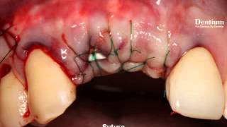 GBR on upper Anterior Esthetic area [upl. by Oremar]