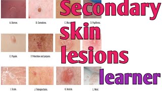 Secondary skin lesions 10 may 2020 [upl. by Senior]