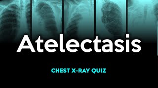 Atelectasis Chest Xray Quiz [upl. by Parsons]