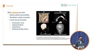 Clinical issues in craniofacial malformations ENT perspective [upl. by Appilihp]