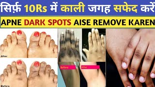 Dark Spots Removal At Home  How To Remove Dark Spots  Dr Saad Ahmed [upl. by Aihsoek773]