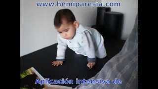 Hemiparesia Infantil  terapia Bobath [upl. by Cammie604]