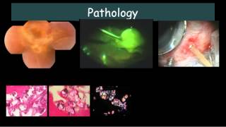 Bilateral Exudative retinal detachment with subretinal exudates Dr E M Dodds [upl. by Vassell]