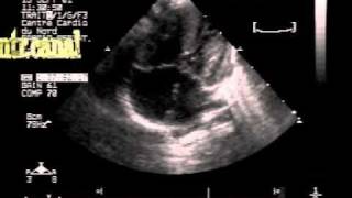 complete atrioventricular canalseptal defect [upl. by Kucik419]