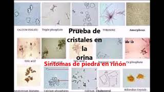 Prueba de cristales en la orina [upl. by Ronna]