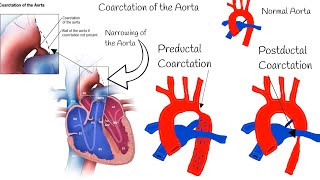 Coarctation of the Aorta  Symptoms Diagnosis and Treatment [upl. by Nevah]