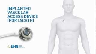 PortaCath Implanted Vascular Access Device [upl. by Pratte645]