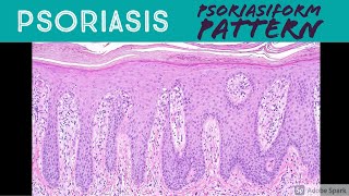 Psoriasis amp Psoriasiform Dermatitis Pattern  Inflammatory Dermpath Basics for Dermatology Pathology [upl. by Myers995]