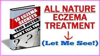 Eczema Treatment  How To Get Rid Of Eczema Naturally [upl. by Orlanta]