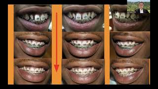 How To Manage PegLateral Incisors and Upper Space teeth [upl. by Anirrehs]