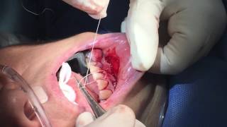 Suturing Alloderm Gum Graft by Dr John Paul Gallardo  Miami FL [upl. by Ttoille]