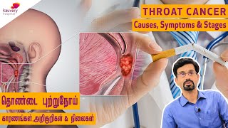 Throat Cancer Causes Symptoms Stages  Tamil [upl. by Ecenaj]