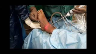 Ankle Arthroscopy Basics Portals Placement amp surgery for Ankle Impingement [upl. by Burl258]