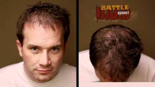 Hair Transplant Results  12 Month Timelapse Before and After  Bosley Medical [upl. by Dnalram363]