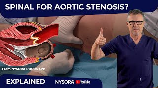 IS SPINAL ANESTHESIA IN AORTIC STENOSIS SAFE [upl. by Ellehsim]