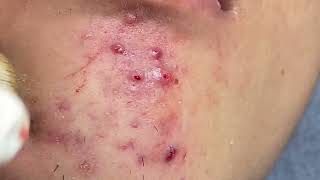 Acne Treatment Huong Da Nang  2024 blackheads 705 [upl. by Rex]