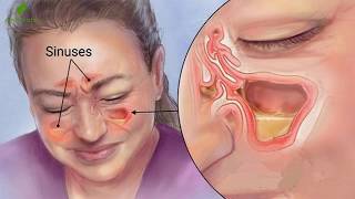 Conoce Como Puedes Eliminar Todo El Moco Y La Flema De Tu Garganta Y Pulmones [upl. by Eatnuahc]