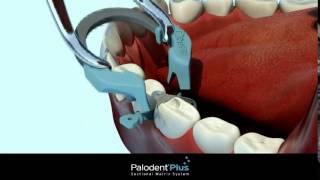 Présentation technique du Palodent Plus  Dentsply [upl. by Kenzi]