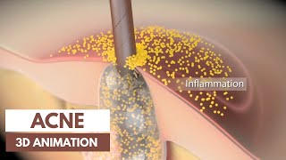 Acne basics  Pathophysiology amp Treatment  3D Animation [upl. by Fisken]